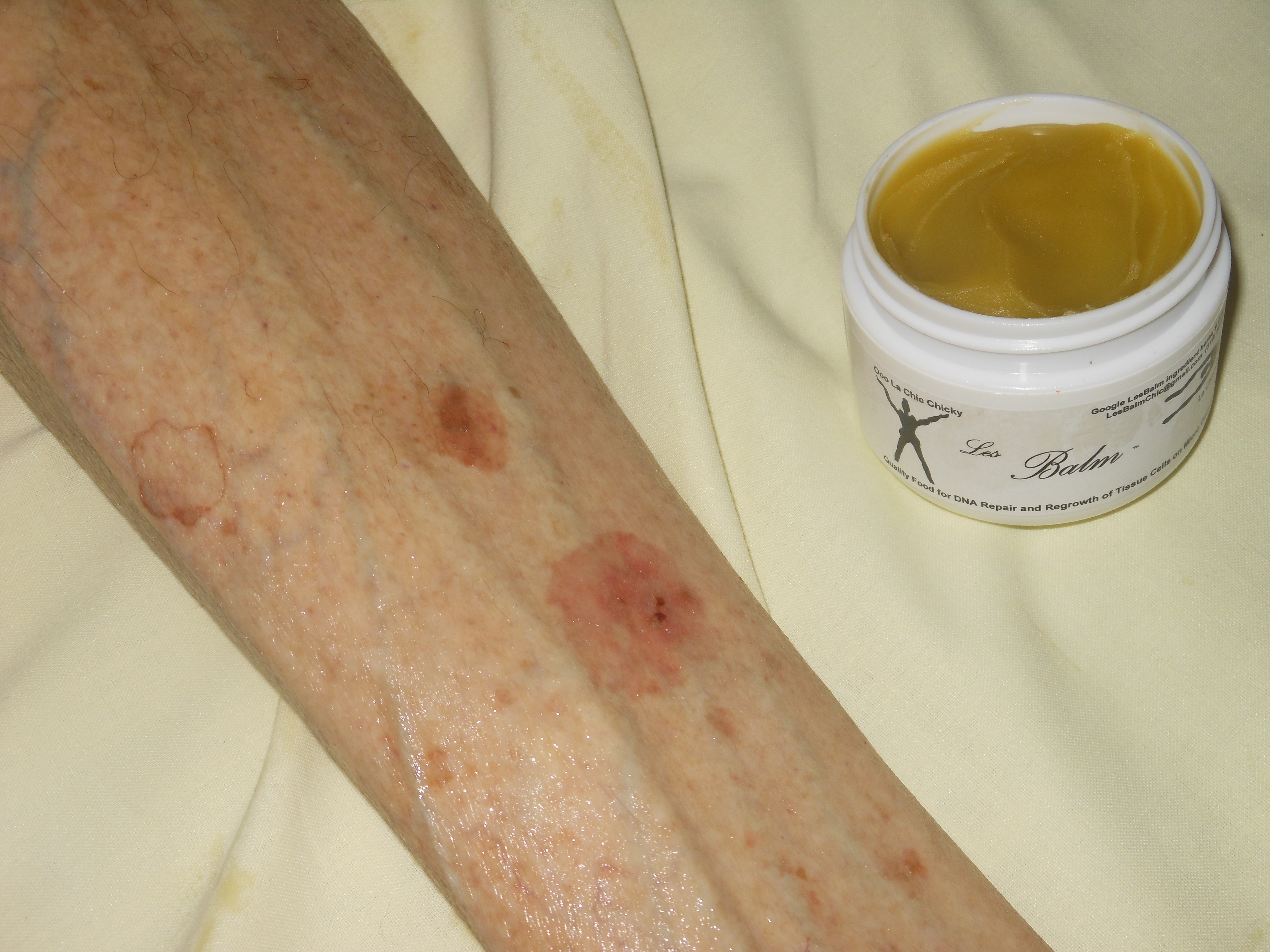 Elderly Skin Healed with 100% Organic, Cannabis Based
      http://www.lesbalm.com.